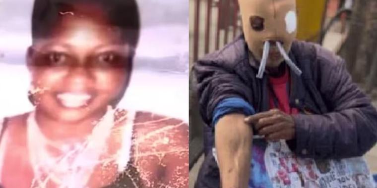 María Consuelo, víctima de ataque con ácido, desistió de la eutanasia tras recibir ayuda para cirugías